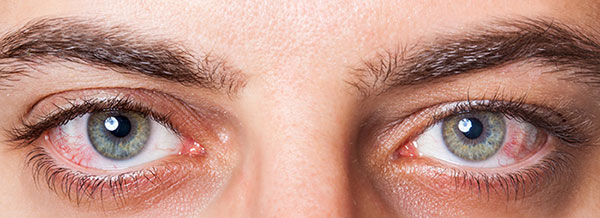 خشکی چشم، علت‌ها و درمان طبیعی