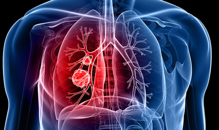 سوئیسی‌ها داروی درمان سرطان ریه را ساختند