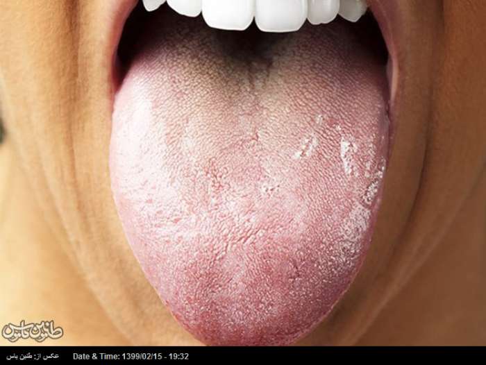 علت سفیدی زبان چیست و چطور می توان آن را درمان کرد؟
