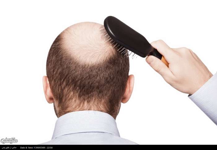 افزایش امید به درمان ریزش مو و طاسی با استفاده از سلول های بنیادی بافت چربی
