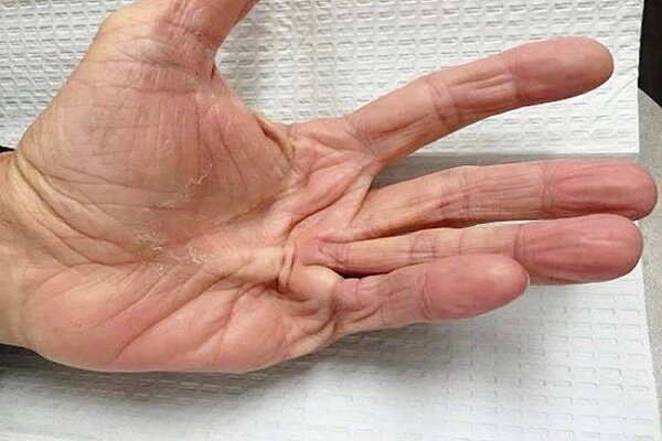 بیماری«کف دست»را بشناسید/مردان بیشتر مراقب باشند