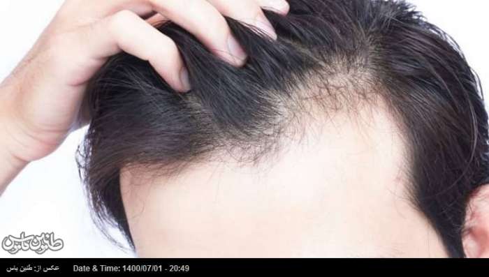 پیشگیری از ریزش مو‌ با ۷ خوراکی موثر