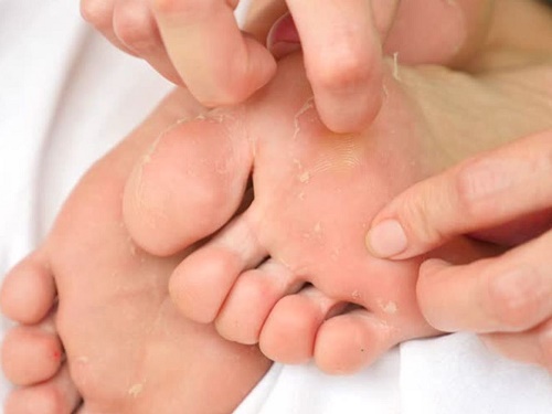 ۵ دلیل رایج پوسته پوسته‌شدن کف پا