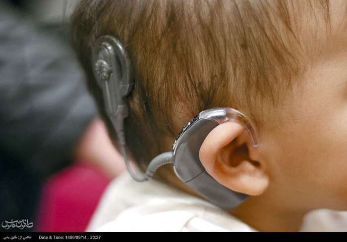 ایران از کشورهای پیشرو در کاشت حلزون شنوایی است