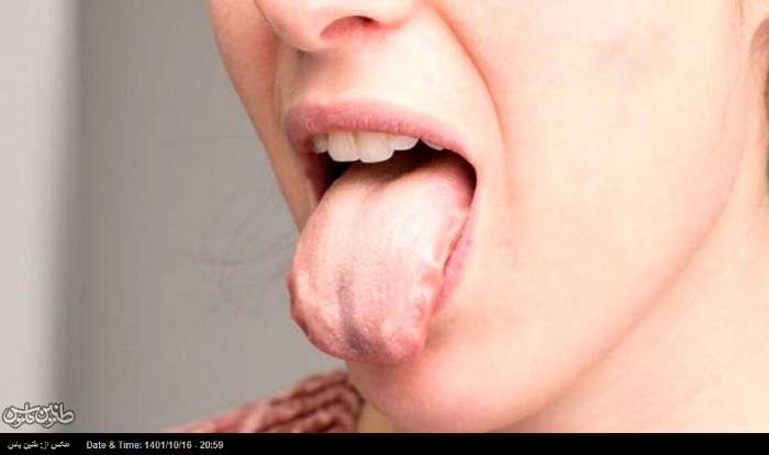 سوزش زبان نشانه این بیماری خطرناک است