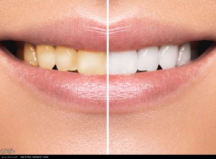 با این روش خانگی و ساده سفیدترین دندان‌ها را داشته باشید