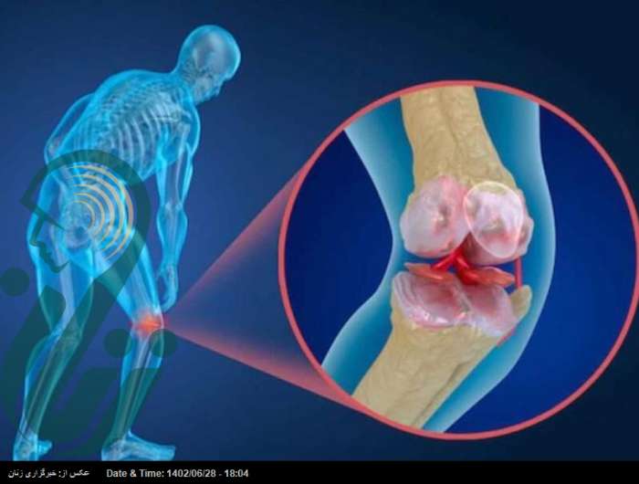 نتایج امیدوار کننده دارویی که پوکی استخوان را درمان می‌کند