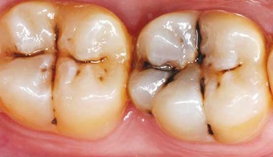 وضعیت دندان‌های خراب در ایران/ از کودکی تا سالمندی
