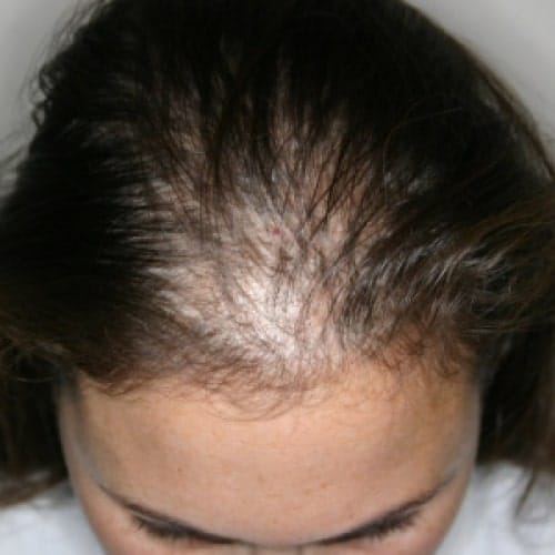 درمان ریزش موی جلوی سر در زنان