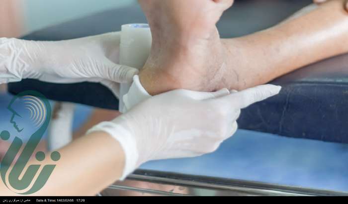 ابداع جوراب‌هایی الکترونیکی برای رهایی‌بخشی بیماران دیابتی از زخم پا