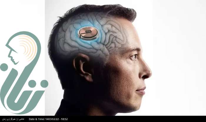 تراشه «تله‌پاتی» ایلان ماسک در مغز یک انسان دچار مشکل شد