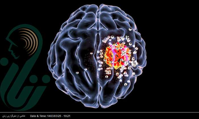 اشعه ایکس با دوز کم می‌تواند سلول‌های تومور مغزی را از بین ببرد!