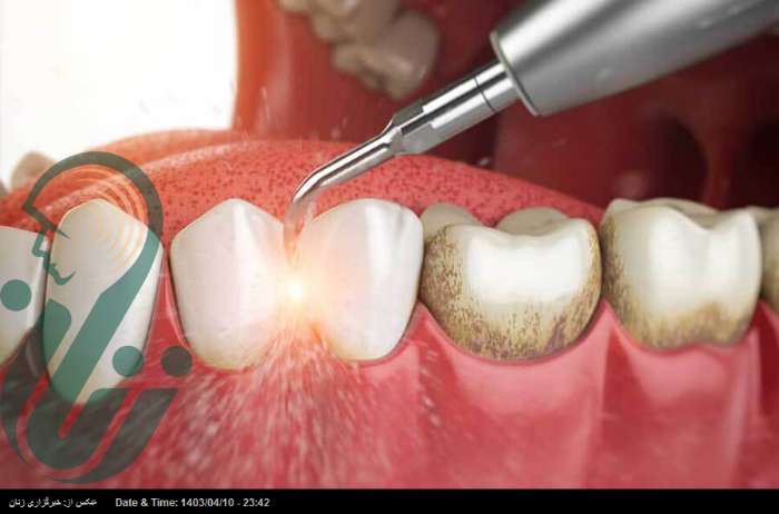 جرم‌گیری هیچ اثر منفی بر مینا و ریشه دندان‌ها ندارد