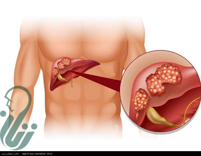 ۴ درصد ایرانی ها درگیر کیست کبدی هستند