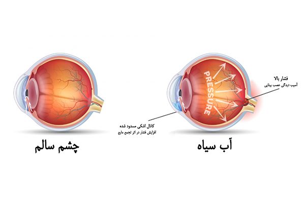 گلوکوم ، آب سیاه و عوارض دیابت از مشکلات شایع چشمی در ایران/ ممنوعیت استفاده از موبایل در کودکان زیر ۲ سال