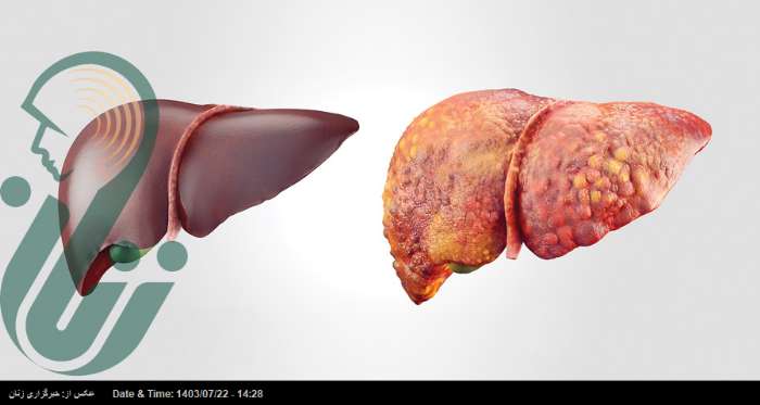 علائم و عوامل ابتلا به کبد چرب