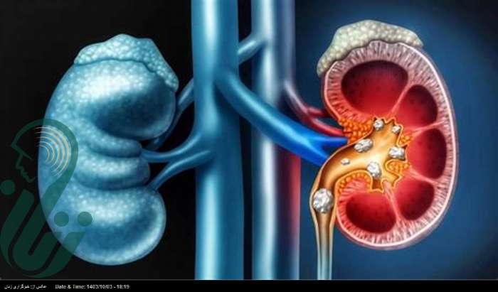 ساده‌ترین راه برای جلوگیری از سنگ کلیه/ این علائم مهم هستند