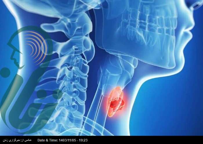 زنان بیشتر از مردان دچار سرطان تیروئید می‌شوند