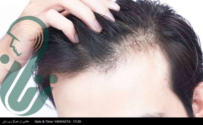 بهترین روش‌ها برای جلوگیری از ریزش مو