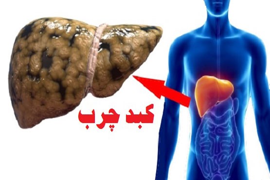 تنها درمان کبد چرب، روزانه نیم ساعت فعالیت تند و کاهش مصرف کربوهیدرات است