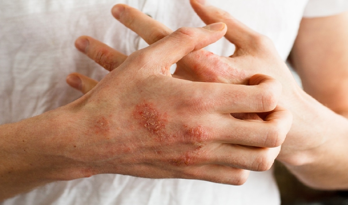 اگزمای پوستی شایع‌ترین بیماری پوستی در زمستان