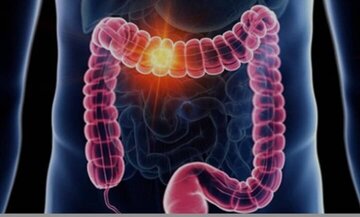 علائم گوارشی را ساده نگیرید/ هر خون‌ریزی هموروئید نیست