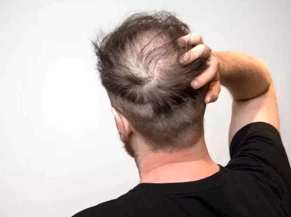 چهار توصیه مهم برای کسانی که ریزش مو دارند