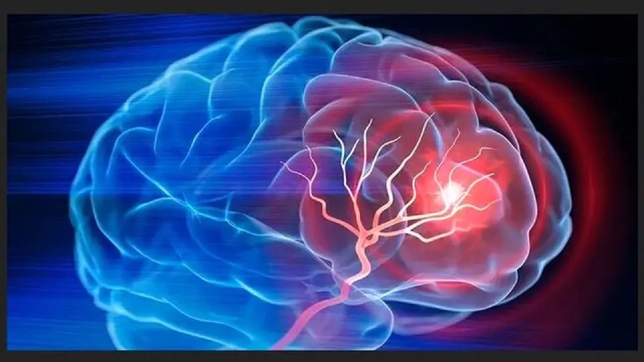 شایع‌ترین علت خونریزی مغزی را بشناسیم