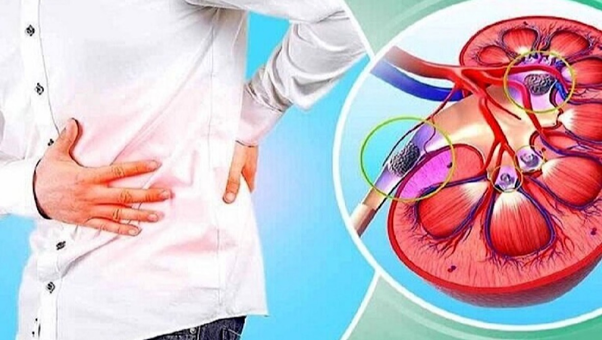 ۴ دشمن سنگ کلیه